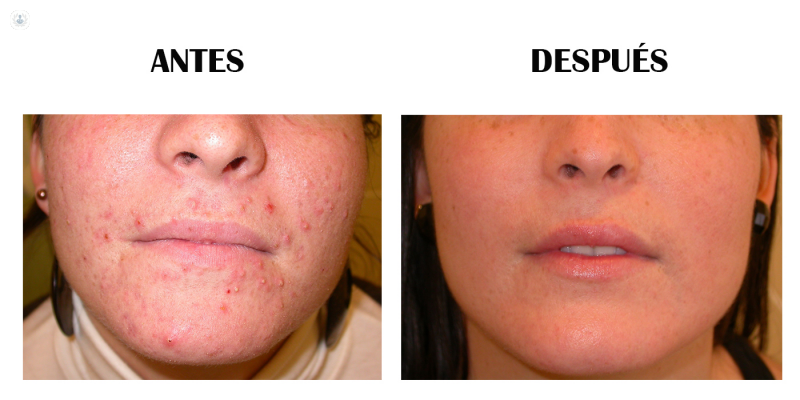 antes y despues acne